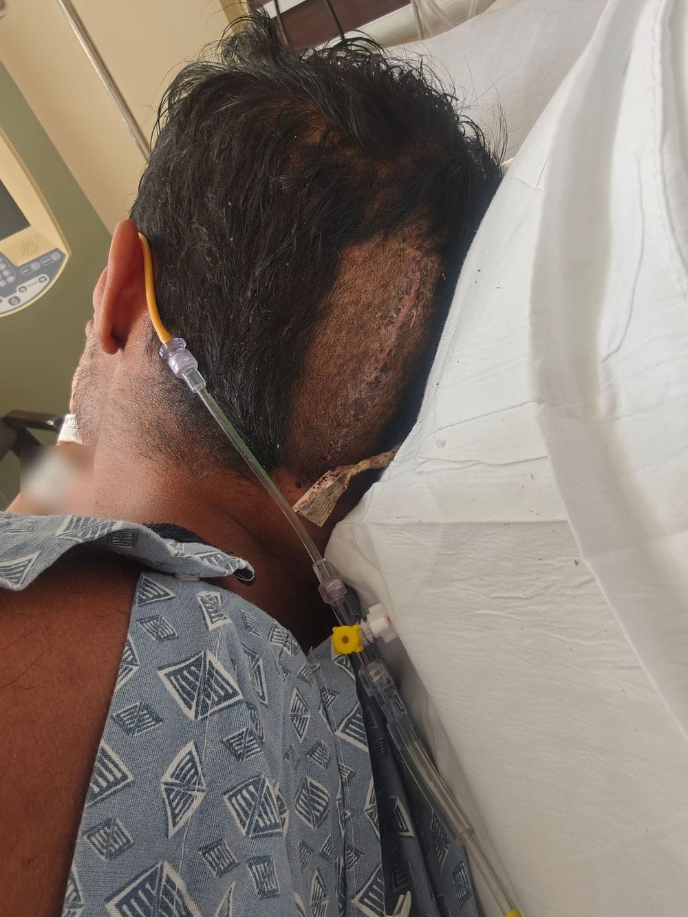 The external ventricular drain line leaving the back of Karamat's head, June 2026