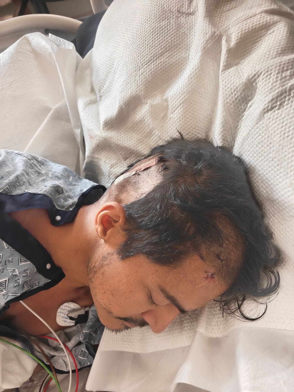 Karamat after the shunt procedure, the dressing on the side of his head