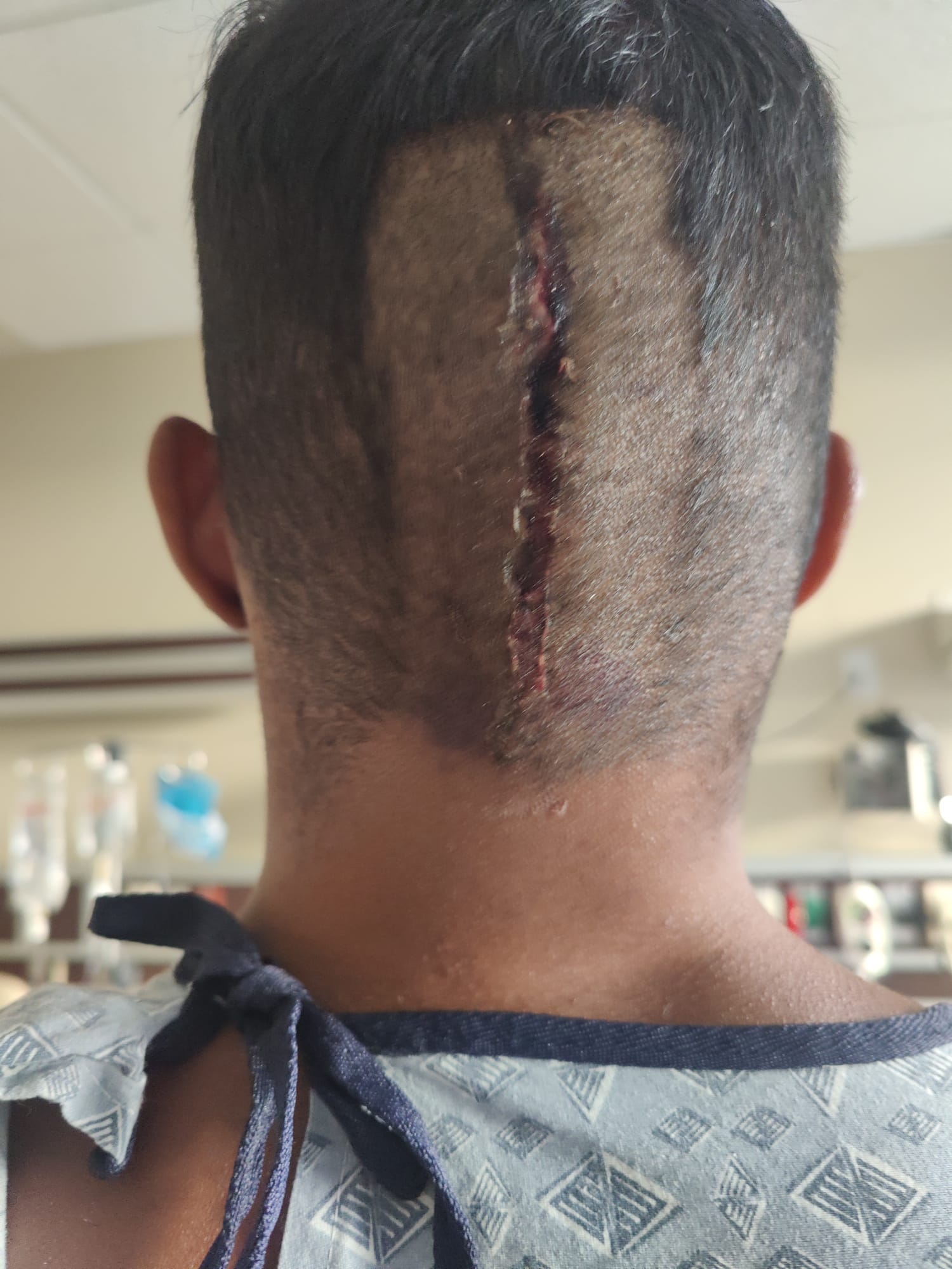 Post-surgery incision — skull-base craniotomy